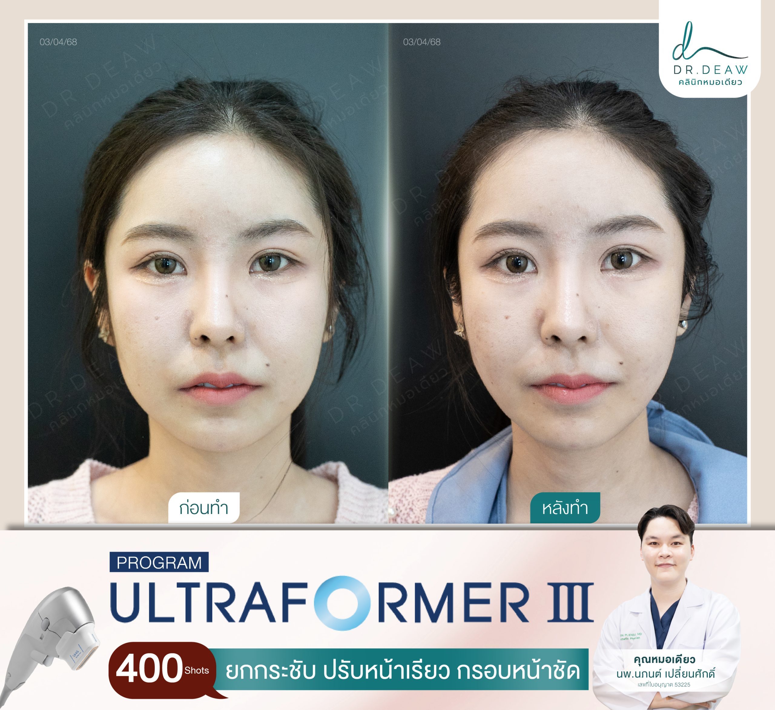 รีวิว Ultraformer